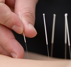 Acupuncture- Natural Healing